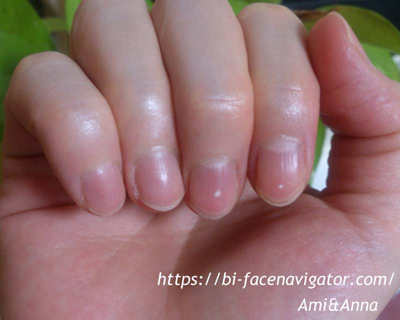 人差し指と中指の中央に出ている爪の白点