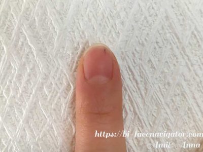 人差し指の爪の黒点